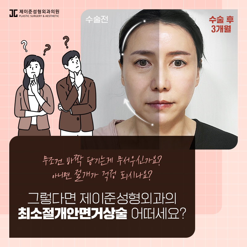 최소절개안면거상술 어떤 수술일까? 관련 이미지 7