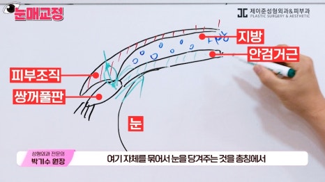 [제이준성형외과&middot;피부과] 눈매교정 파헤치기! 하나부터 열까지 싹~ 알려드립니다! 관련 이미지 7