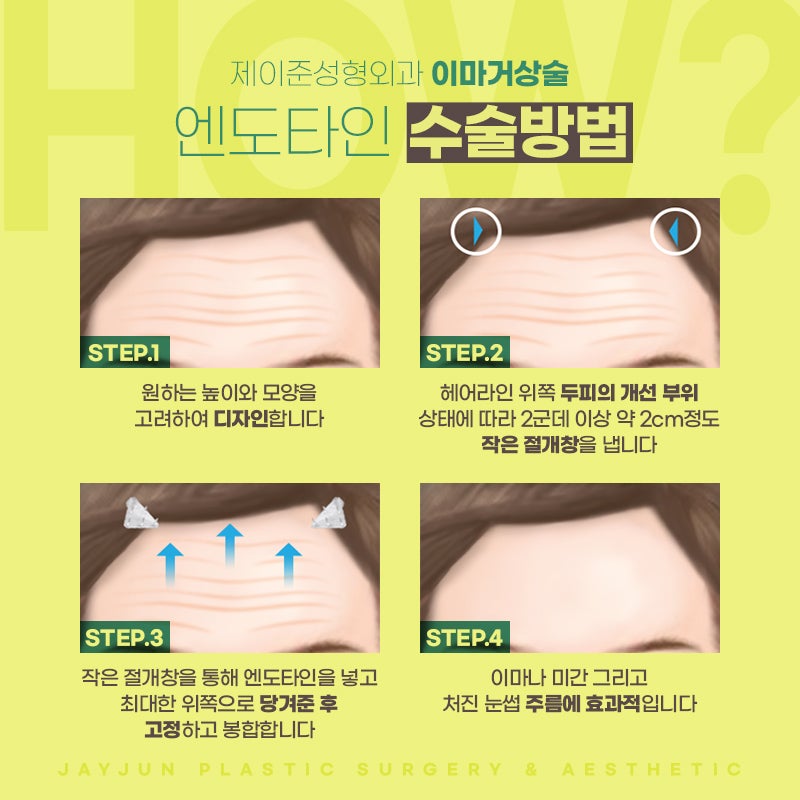엔도타인 이마거상술 추천드리는 곳 관련 이미지 5