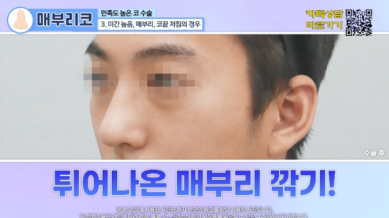 [제이준 유튜브] 유형별 코 성형, 가장 만족도 큰 매부리 코! 관련 이미지 11