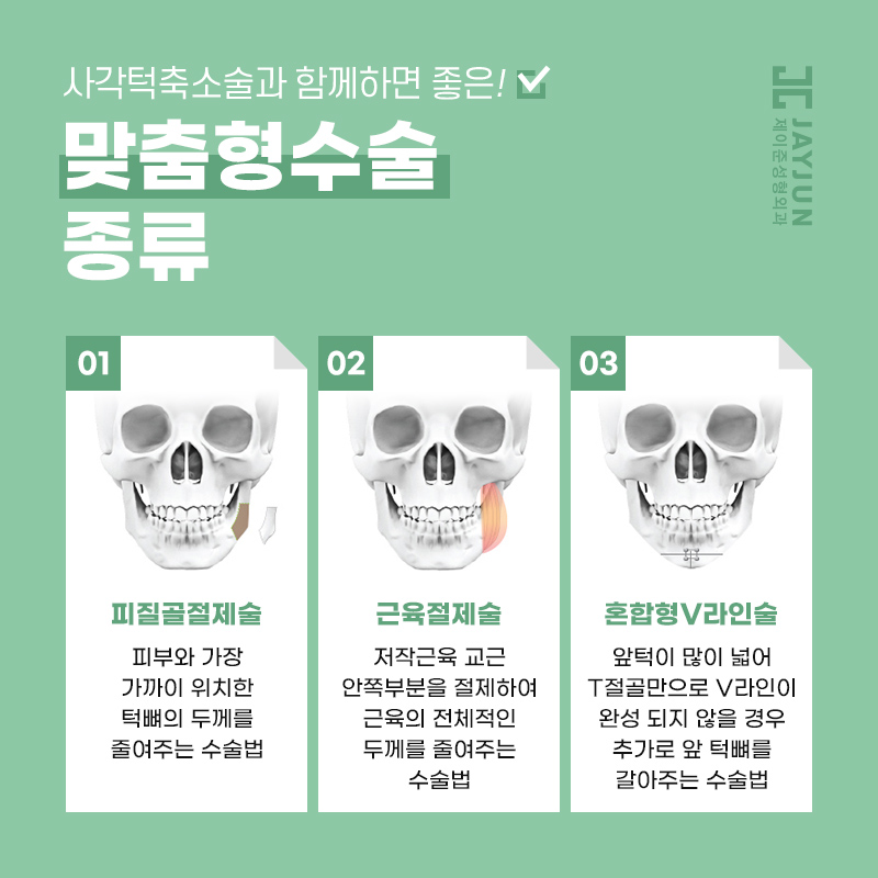 어느 각도에서 봐도 갸름한 얼굴형! 제이준 사각턱축소술 관련 이미지 5