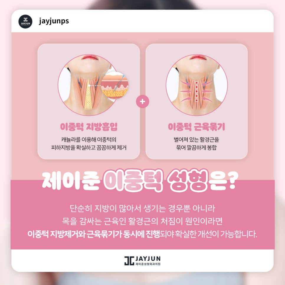 한번에 확실하게! 제이준 이중턱 지방흡입 & 근육묶기 관련 이미지 4