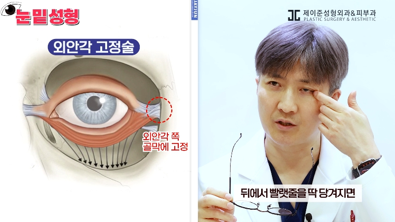 [Jeijun Plastic Surgery & Dermatology&middot;] Lower Blepharoplasty? Lower Eyelid Fat Repositioning? Read This Before Deciding! image 15