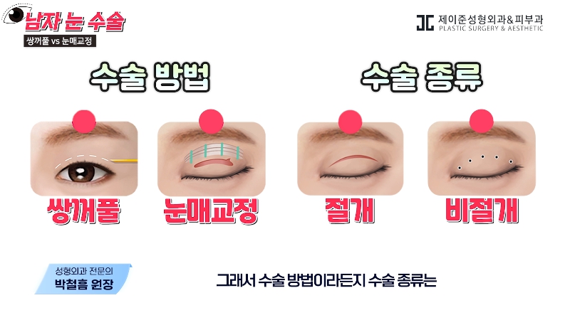 [제이준성형외과&middot;피부과] 남자 눈을 키우는 두 가지 방법! 쌍꺼풀 vs 눈매교정 관련 이미지 12