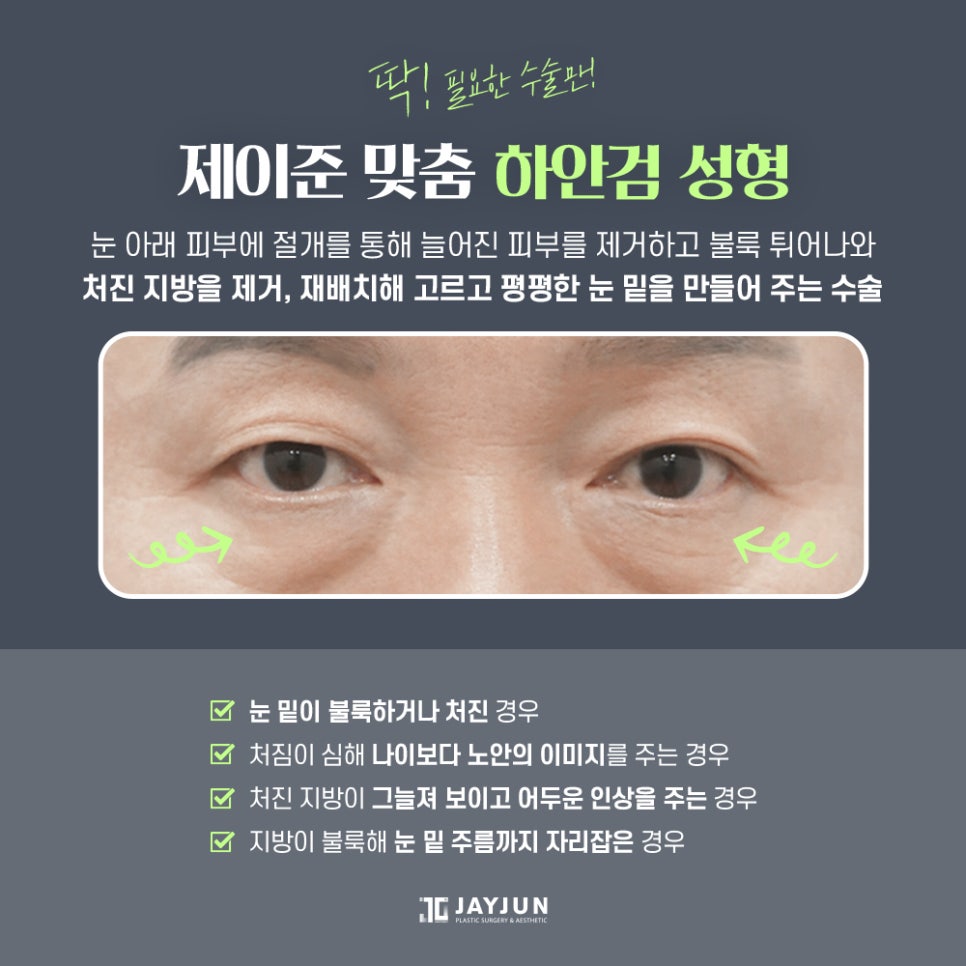 [제이준 성형외과] 미용+기능 동시에 잡는 제이준 중년 눈성형 관련 이미지 4