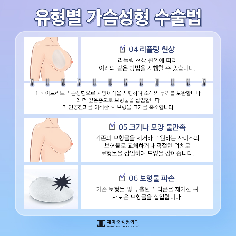 가슴재수술 , 실패 원인에 따른 수술 계획이 중요 관련 이미지 5