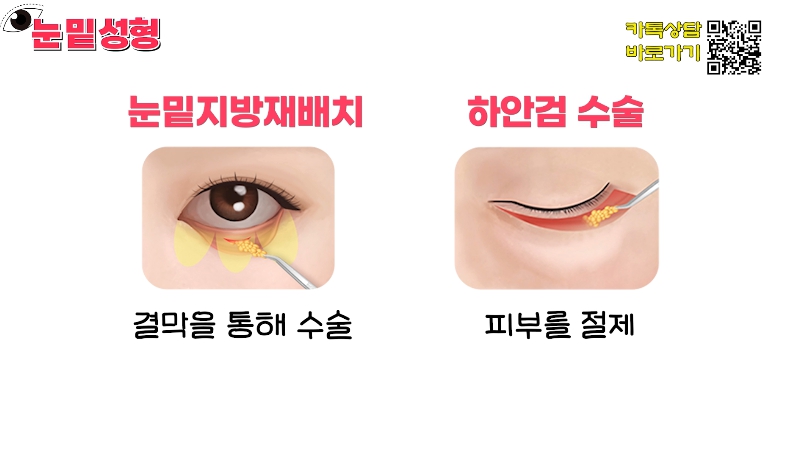 [Jeijun Plastic Surgery & Dermatology&middot;] Lower Blepharoplasty? Lower Eyelid Fat Repositioning? Read This Before Deciding! image 11