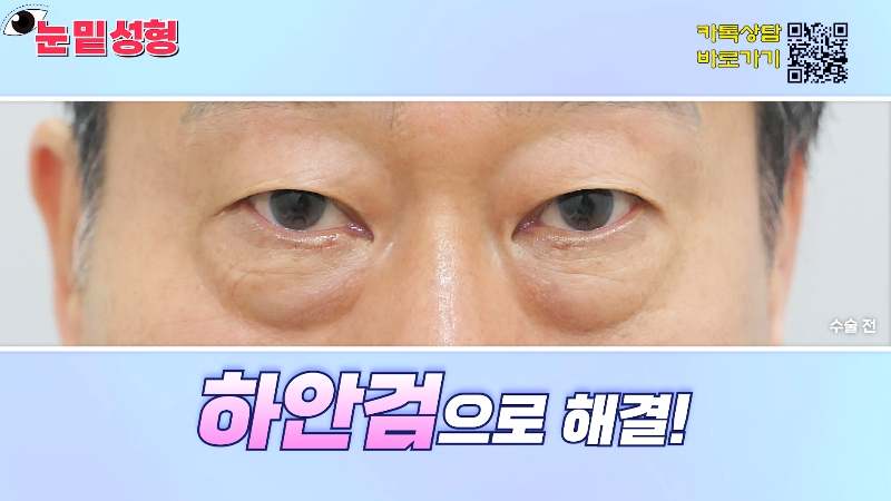 [Jeijun Plastic Surgery & Dermatology&middot;] Lower Blepharoplasty? Lower Eyelid Fat Repositioning? Read This Before Deciding! image 27