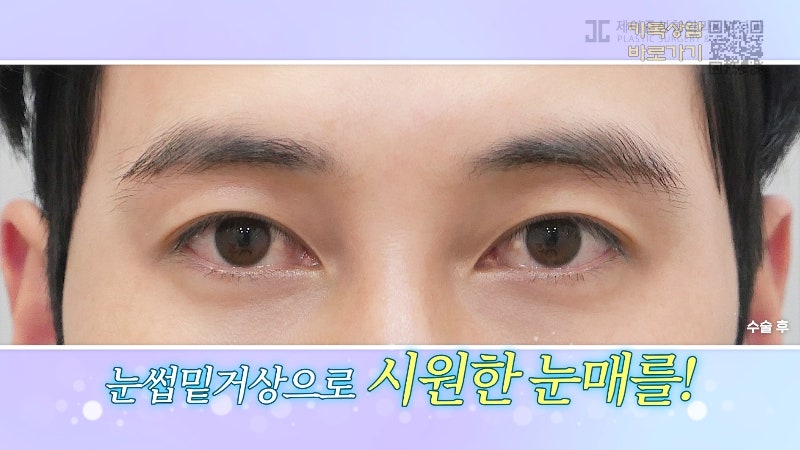 [Jayjun Plastic Surgery & Dermatology] Worried about drooping eyelids? Solve sagging eyes with a brow lift under the eyebrows without double eyelid surgery! image 12