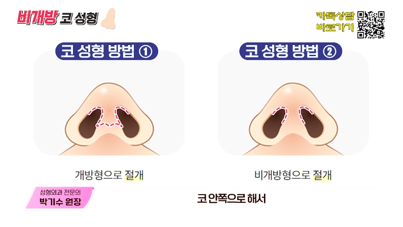 [제이준성형외과&middot;피부과] 흉터 없이 달라지는 코의 비밀! 비개방 코성형의 모든 것! 관련 이미지 2