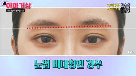 [제이준 유튜브] 쌍수 하러  갔는데 이마거상을 추천하는 이유?! 관련 이미지 9