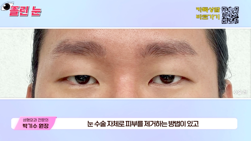 [제이준성형외과&middot;피부과] 졸려보이는 눈과 이마 주름의 상관관계? 관련 이미지 12
