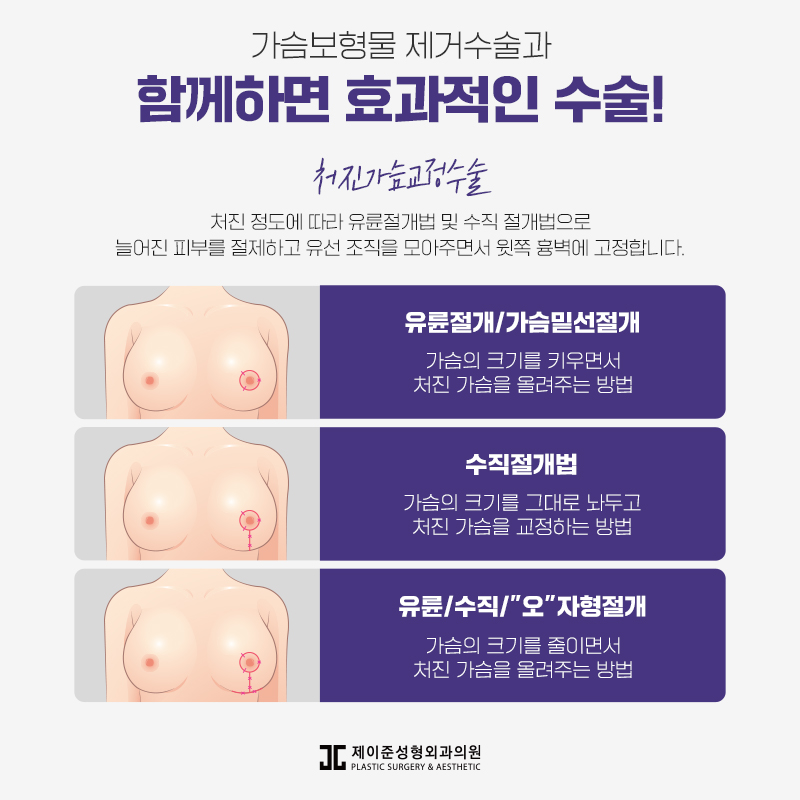 가슴보형물제거 어떤 수술일까? 관련 이미지 5