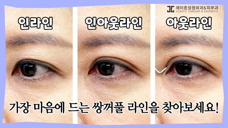 [제이준성형외과&middot;피부과] 내 눈에 찰떡인 쌍꺼풀 라인! 미리 찾아보기👀 관련 이미지 12
