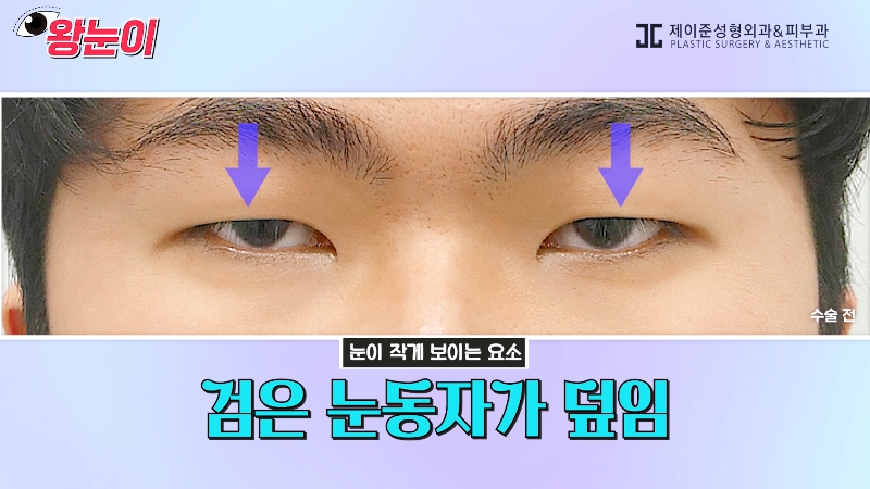 [제이준성형외과&middot;피부과] 제이준성형외과 박철흠 원장님이 알려주는 눈이 커지는 방법 핵심요약! 관련 이미지 10