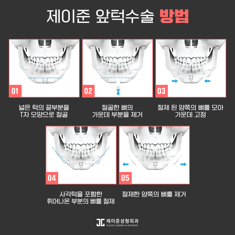 갸름한 얼굴형을 위한 앞턱수술 관련 이미지 5