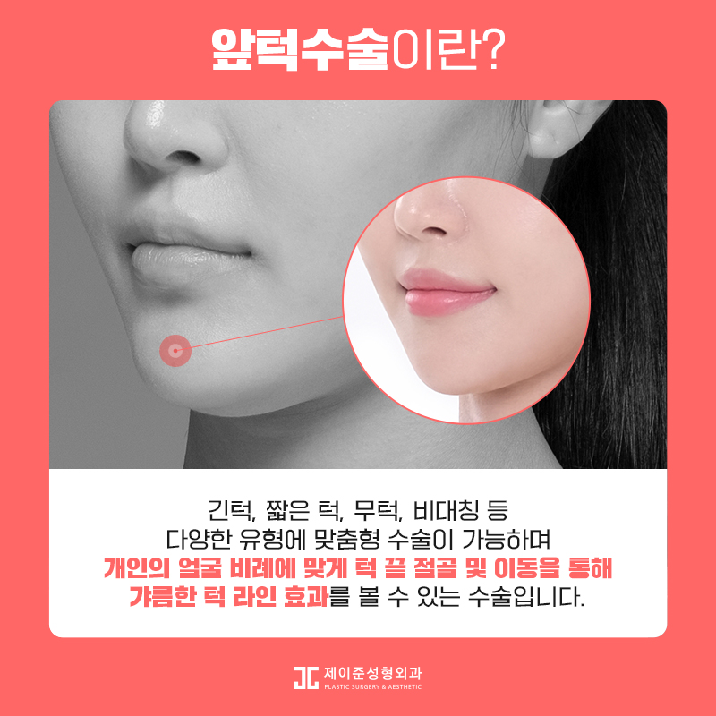 갸름한 얼굴형을 위한 앞턱수술 관련 이미지 3