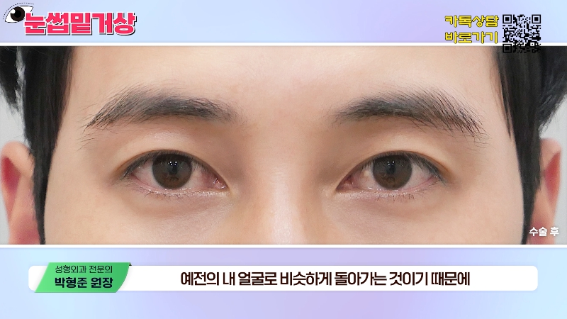 [Jayjun Plastic Surgery & Dermatology] Worried about drooping eyelids? Solve sagging eyes with a brow lift under the eyebrows without double eyelid surgery! image 5