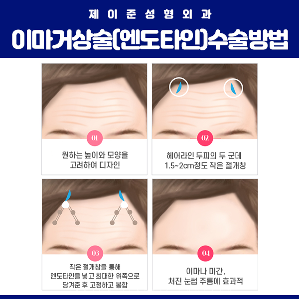 제이준성형외과│내시경 엔도타인 이마거상술은 오화영 원장님과 함께 관련 이미지 4