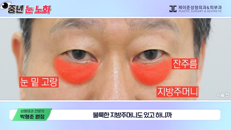 [제이준성형외과&middot;피부과] 🚨성형외과 전문의가 알려주는 눈 노화 신호🚨 관련 이미지 20
