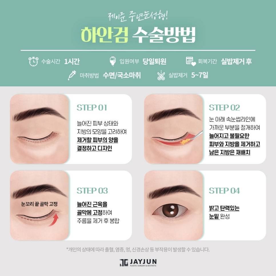 [제이준성형외과] 매끈하고 탄력있는 눈 밑으로! 중년눈성형 하안검 관련 이미지 6