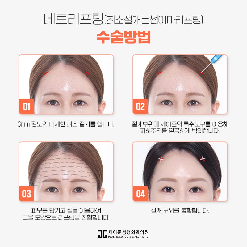 네트리프팅 어떤 수술일까? 관련 이미지 7