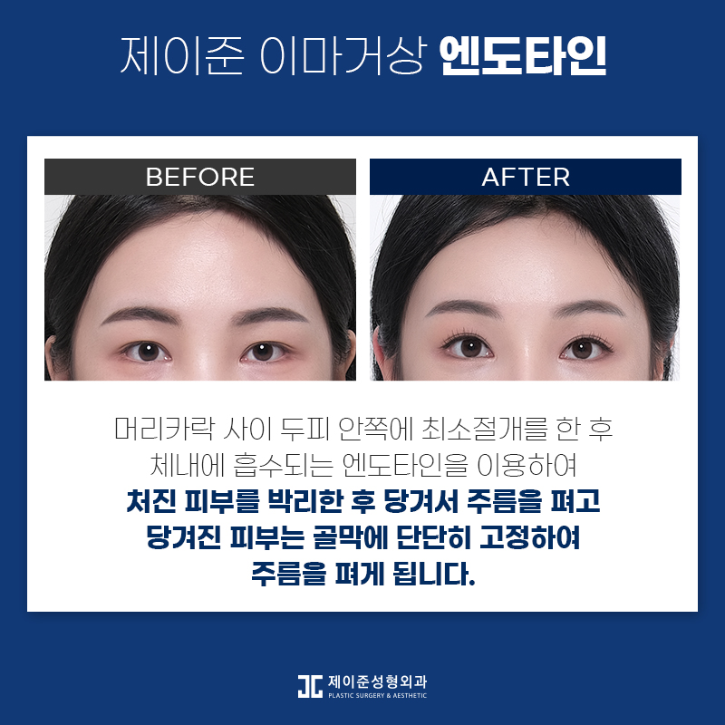 노화증상 개선하고 동안외모로! 엔도타인 이마거상술 관련 이미지 2