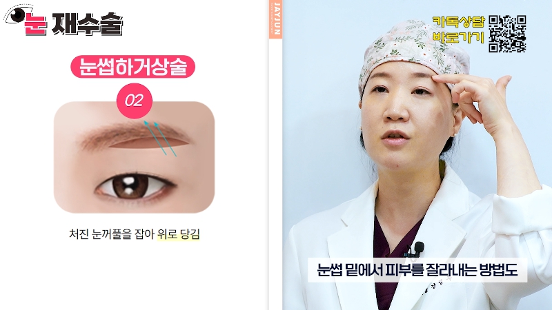 [Jeijun Plastic Surgery &amp; Dermatology] Everything a plastic surgery specialist wants you to know about eyelid revision surgery! Customized methods by case! image 21