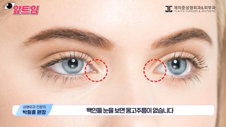 [Jaejune Plastic Surgery & Dermatology] Why is epicanthoplasty necessary? Everything about epicanthoplasty!! image 20