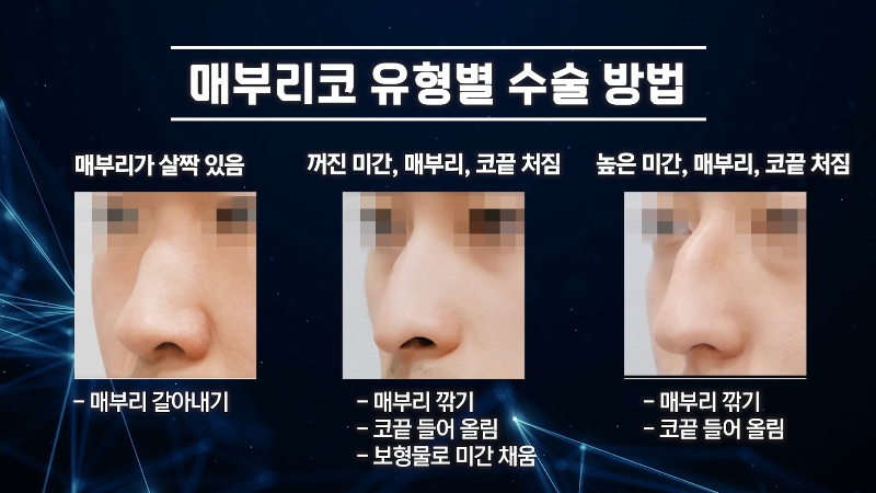 [제이준 유튜브] 유형별 코 성형, 가장 만족도 큰 매부리 코! 관련 이미지 17