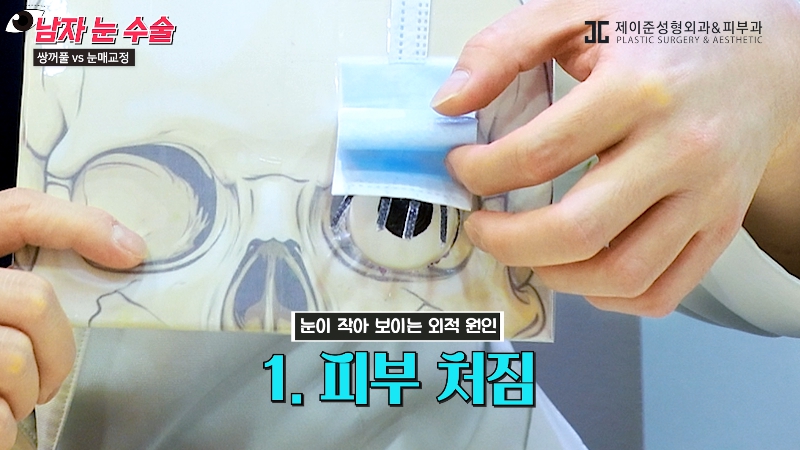 [제이준성형외과&middot;피부과] 남자 눈을 키우는 두 가지 방법! 쌍꺼풀 vs 눈매교정 관련 이미지 4