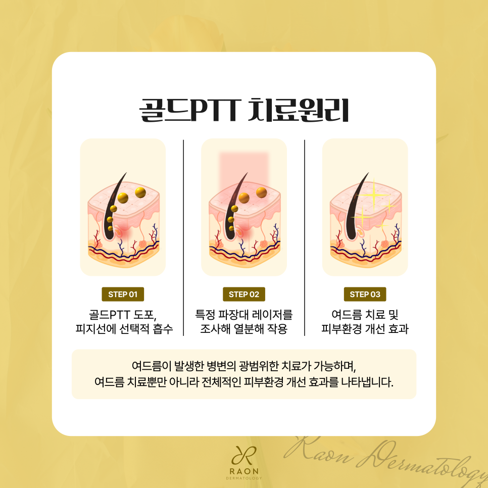 왕십리 피부과 전문의의 여드름 치료 골드PTT로 피지 억제 가능할까 관련 이미지 4