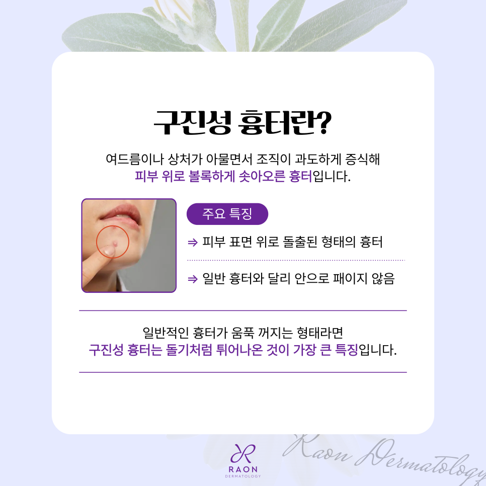 왕십리 피부과 포텐자 고주파를 이용한 원데이 구진성 흉터 치료 관련 이미지 2