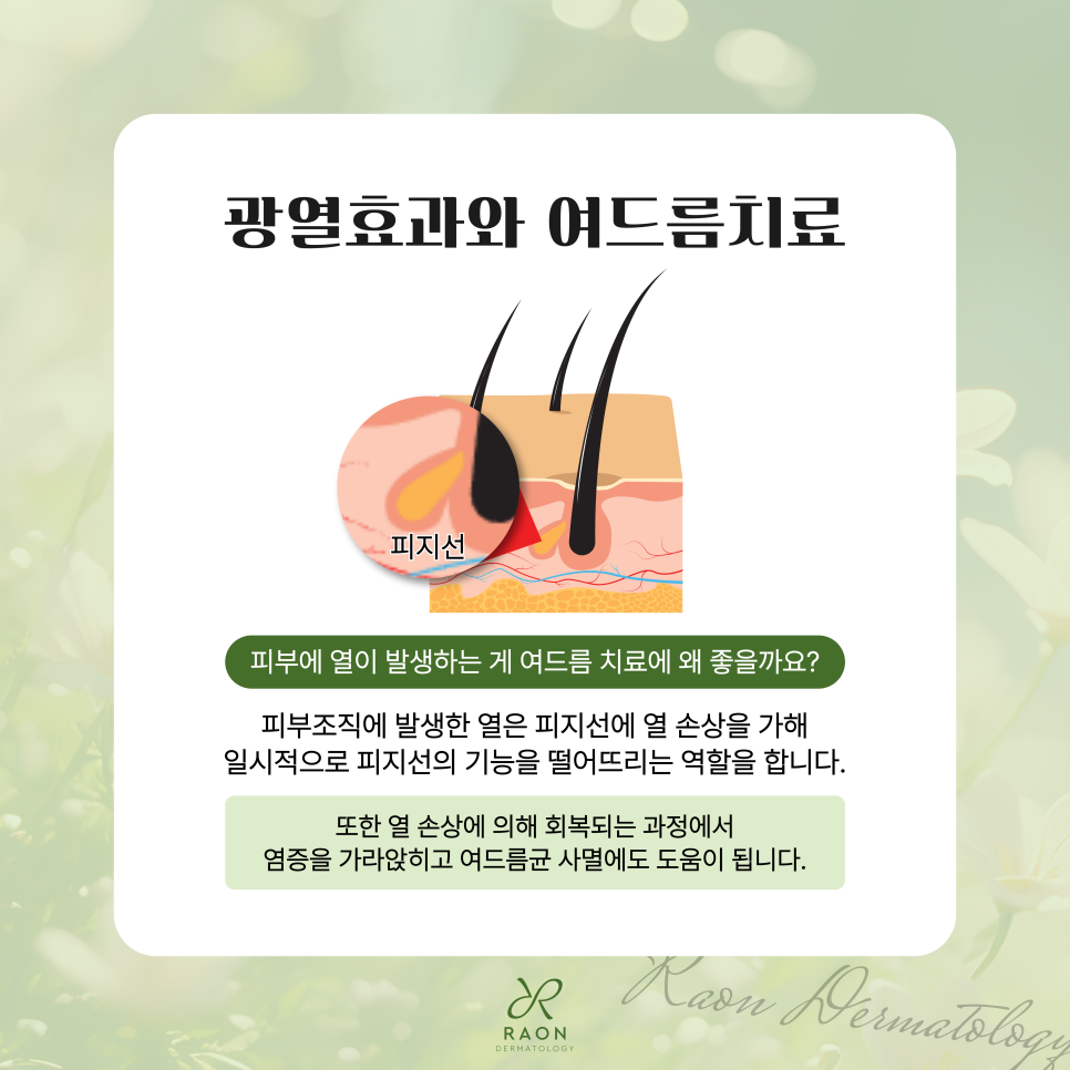 Chief Director’s Skin Column｜What Are the Limitations of Acne Laser Treatment at a Dermatology Clinic in Haengdang-dong? image 3