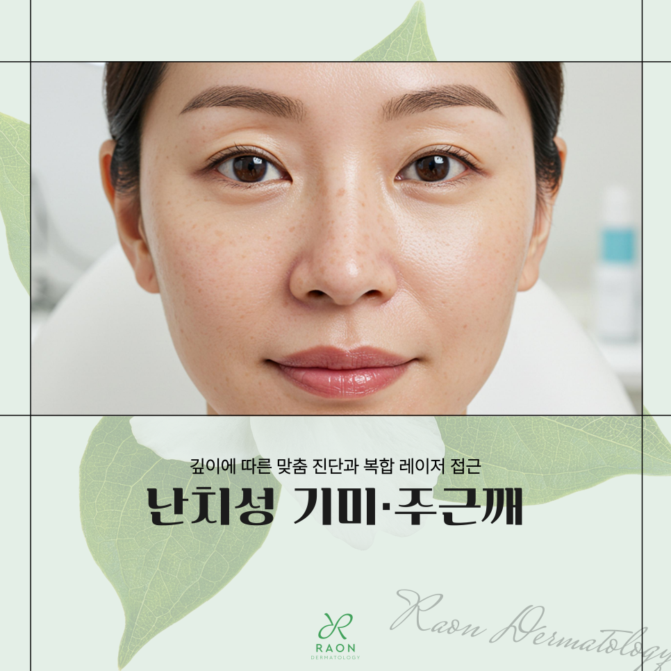 성수피부과 난치성 기미 및 주근깨 피부과 전문의 진료 후 레이저 토닝 치료 관련 이미지 1