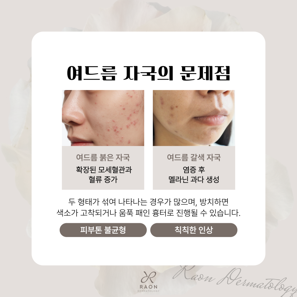 Ha-wangsimni Dermatology: Laser Treatment for Acne Marks — Why Is Two or More Lasers Necessary? image 2