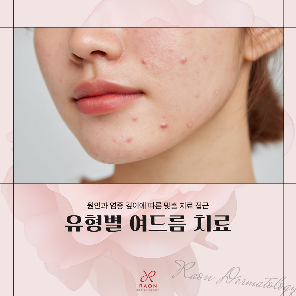 Recurring Acne That Keeps Coming Back: Acne Treatment Methods by Type at Haengdang Station Dermatology Clinic (Including Sebaceous Gland Destruction, Black Peel) image 1