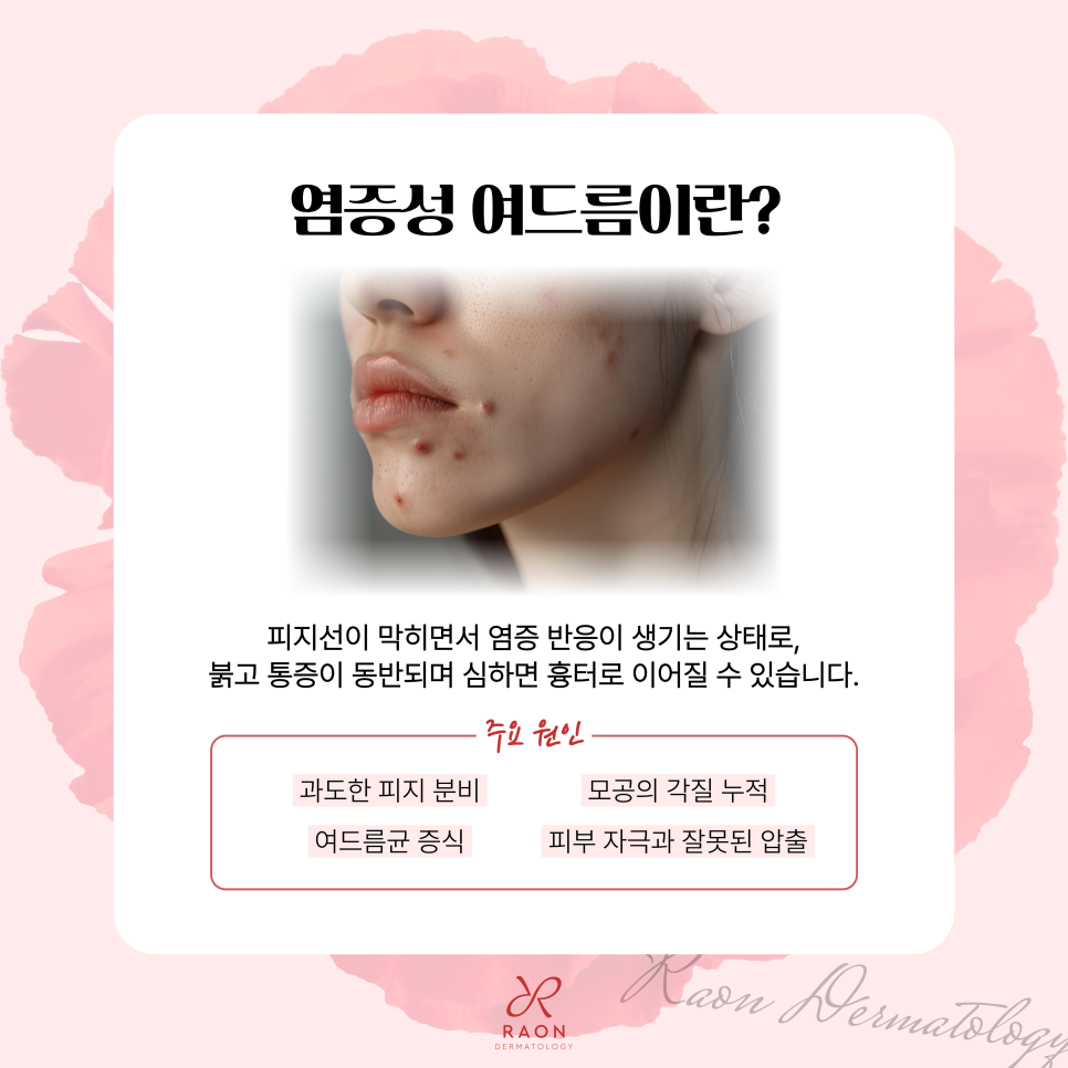 왕십리 피부과 염증성 여드름 치료, 압출만으로는 부족한 이유? 관련 이미지 2