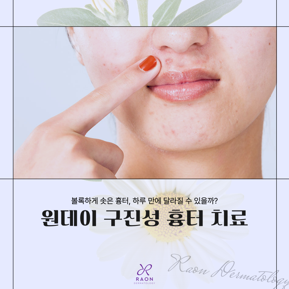 왕십리 피부과 포텐자 고주파를 이용한 원데이 구진성 흉터 치료 관련 이미지 1