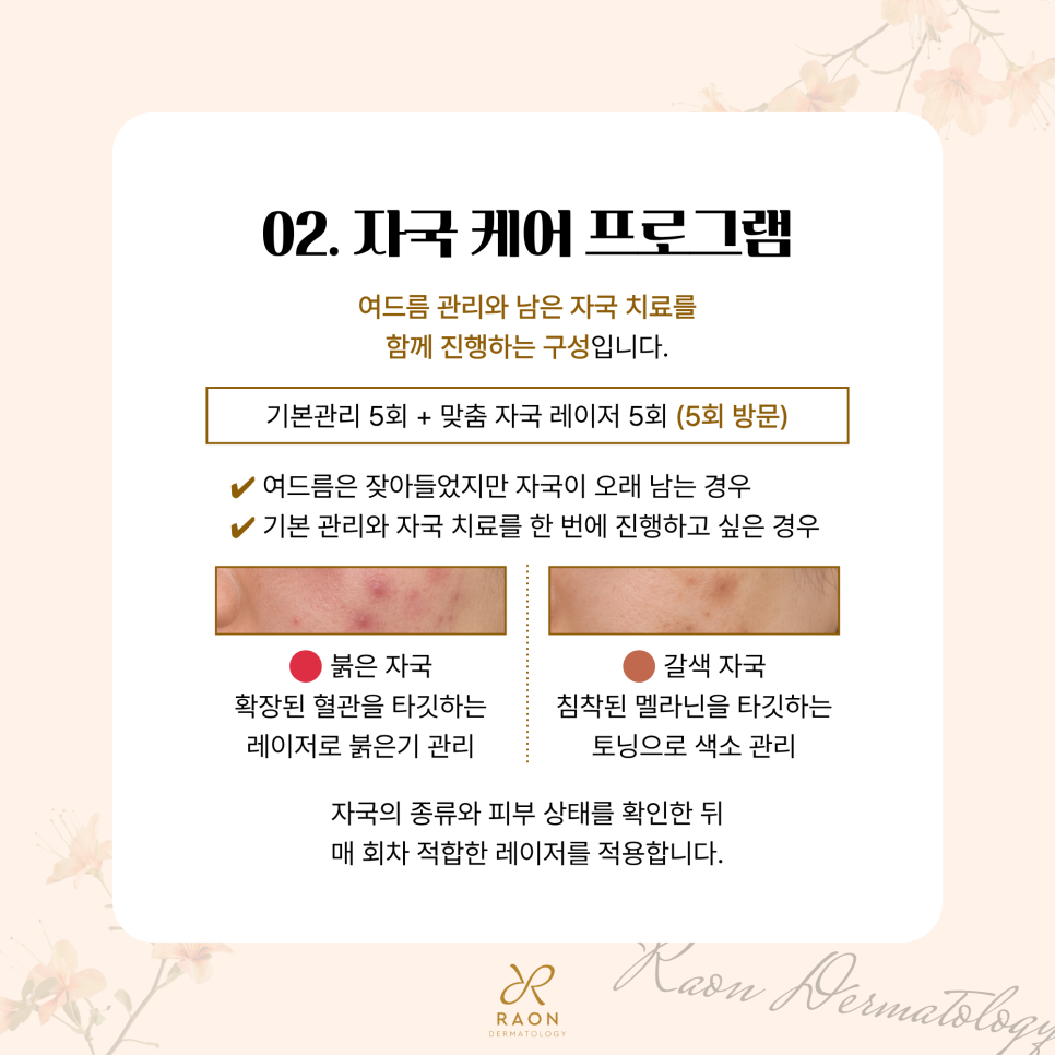 성동구 피부과 전문의 3가지 여드름 및 여드름 자국 집중 치료 과정 미리보기 관련 이미지 4