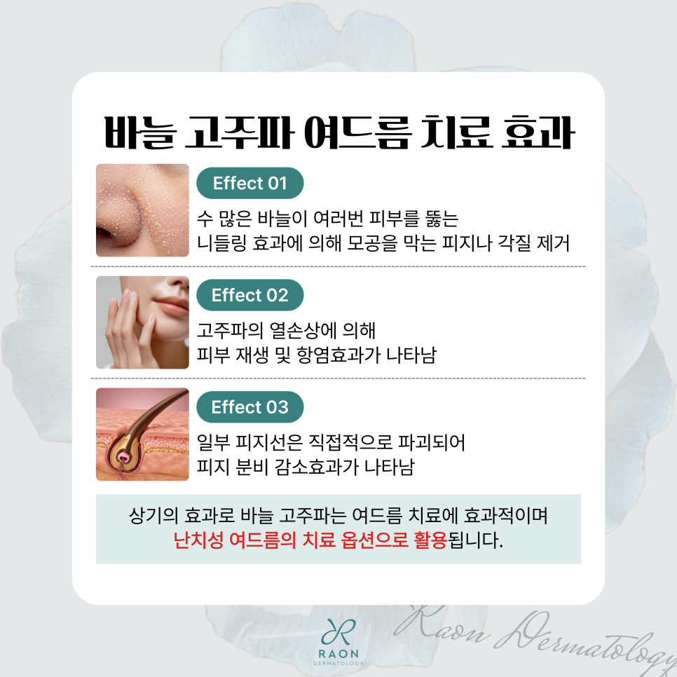 성동구 피부과 바늘 고주파 여드름 치료 이해하기 2편 [백종헌 원장 칼럼] 관련 이미지 5