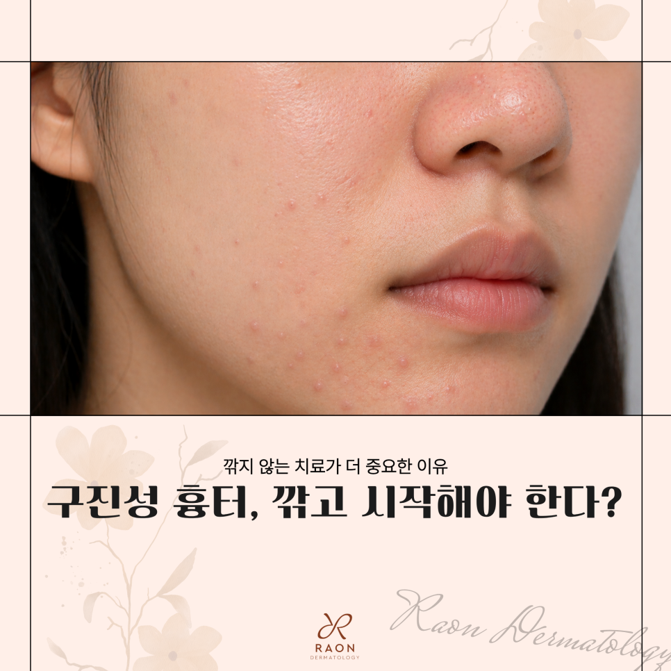 Seongdong-gu Dermatology: Is Shaving-Off Treatment the Only Answer for Papular Scars and Hypertrophic Scars? [Chief Director Skin Column] image 1