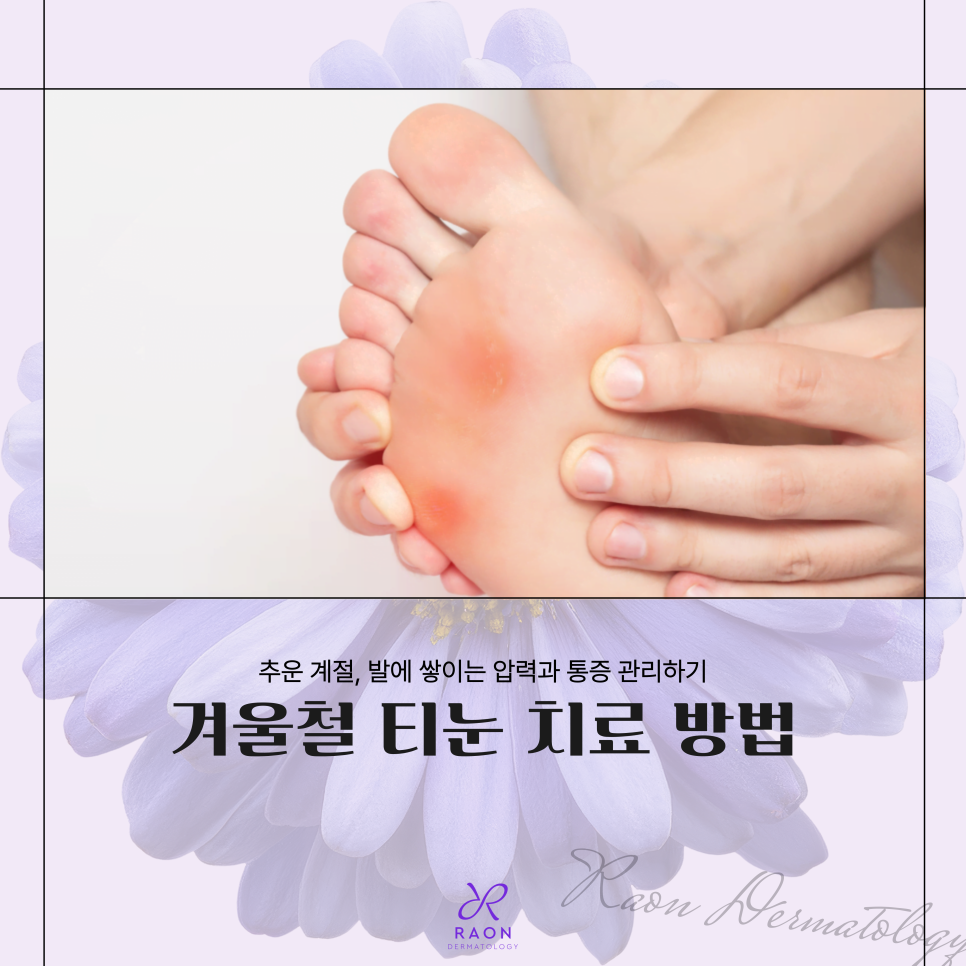 금호동 피부과 전문의 겨울철 티눈 치료는 이렇게, 더 효과적인 치료 방법은? 관련 이미지 1