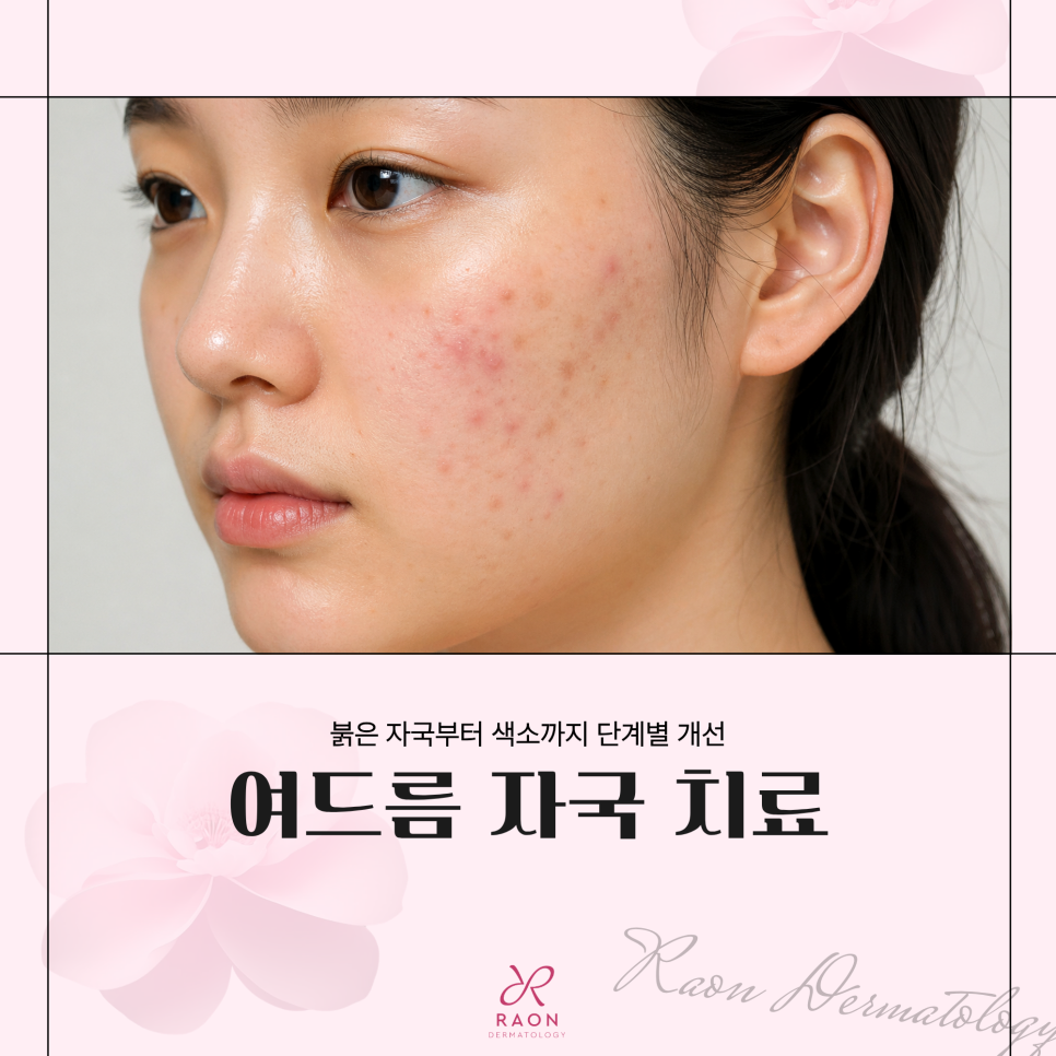 Gangdong-dong Dermatology Specialist Acne Inflammation Mark Treatment Preview, Including Laser Treatment image 1