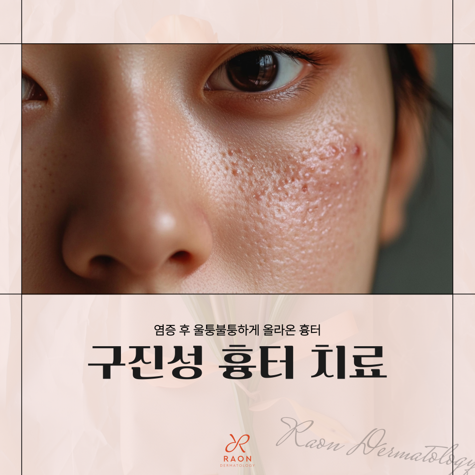 How Does a Dermatology Specialist in Wangsimni Treat Papular Scars and Hypertrophic Scars? image 1