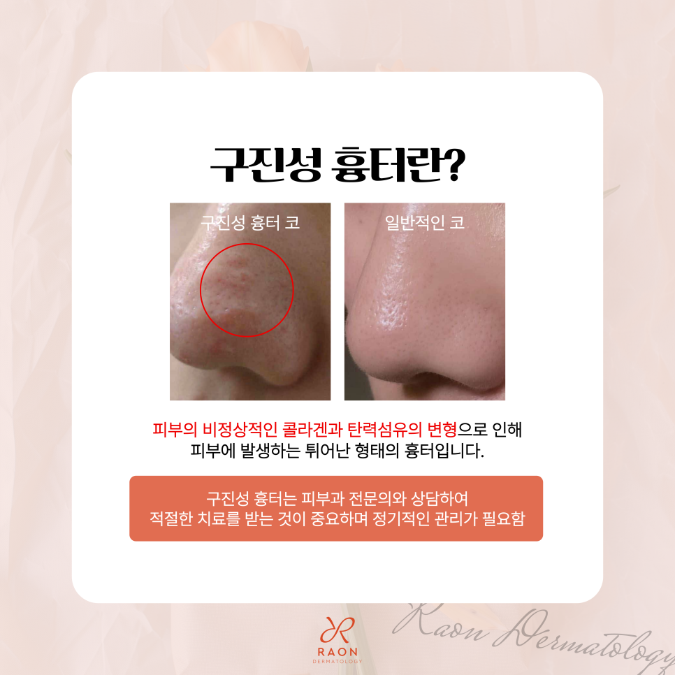 How Does a Dermatology Specialist in Wangsimni Treat Papular Scars and Hypertrophic Scars? image 2