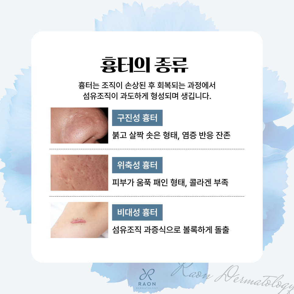 Hoehyeon Station Dermatology: Characteristics and Treatment Methods by Scar Type, and What Are the Benefits of Combining Mirajet and Juvelook? image 2