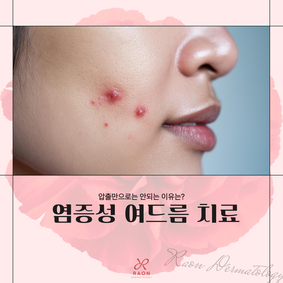 왕십리 피부과 염증성 여드름 치료, 압출만으로는 부족한 이유? 관련 이미지 1