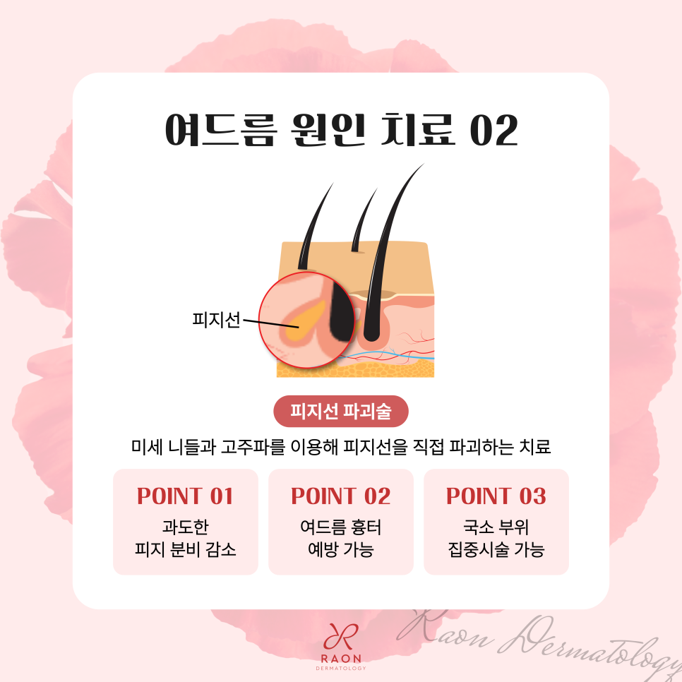 왕십리 피부과 염증성 여드름 치료, 압출만으로는 부족한 이유? 관련 이미지 4