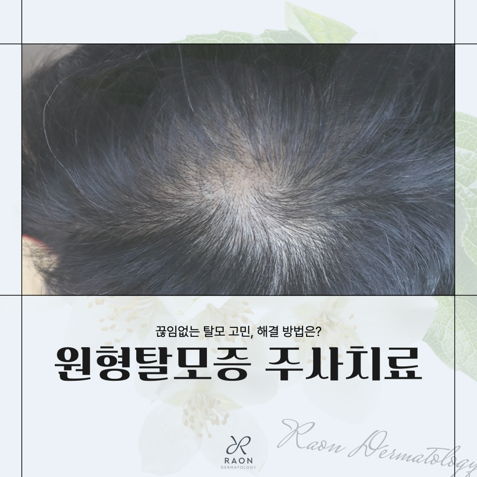 성동구 피부과 원형탈모증 트리암시놀론 주사, 초기 탈모 치료효과는? 관련 이미지 1